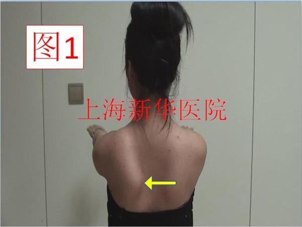 翼状肩胛(副神经损伤)典型病例