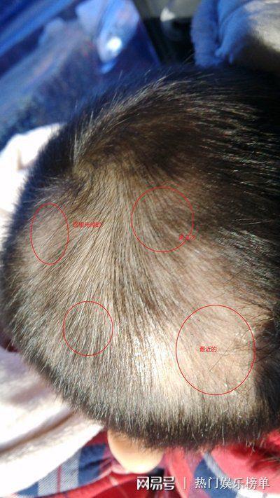 幼童斑秃竟是甲醛超标所致专家建议家中除甲醛用这几个方法