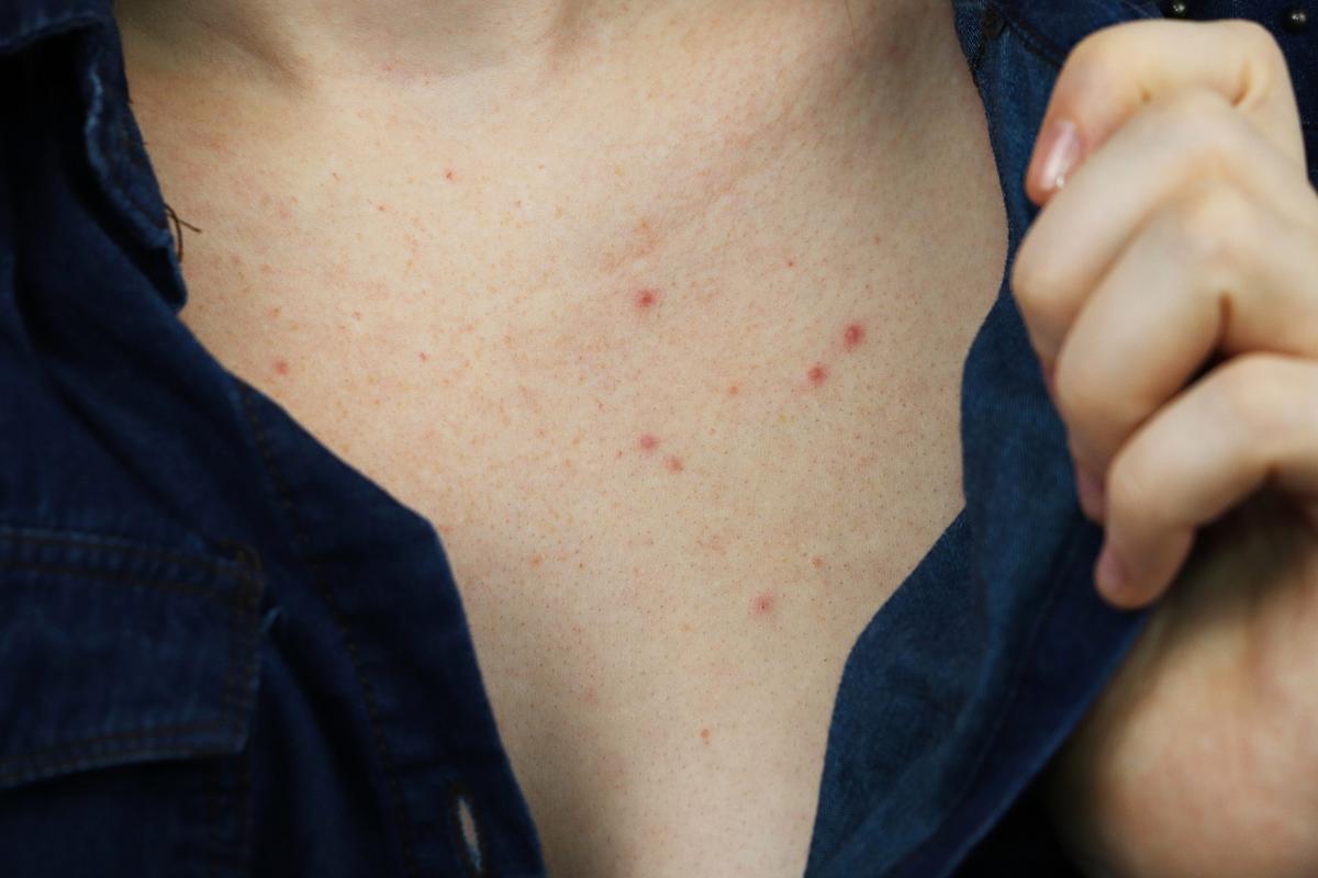 这些小痘痘可能是由多种因素引起的,如毛孔堵塞,皮脂过多,细菌感染或