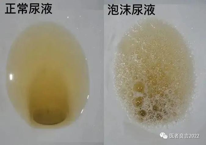 尿中有很多泡沫是什么原因是肾不好还是有尿毒症