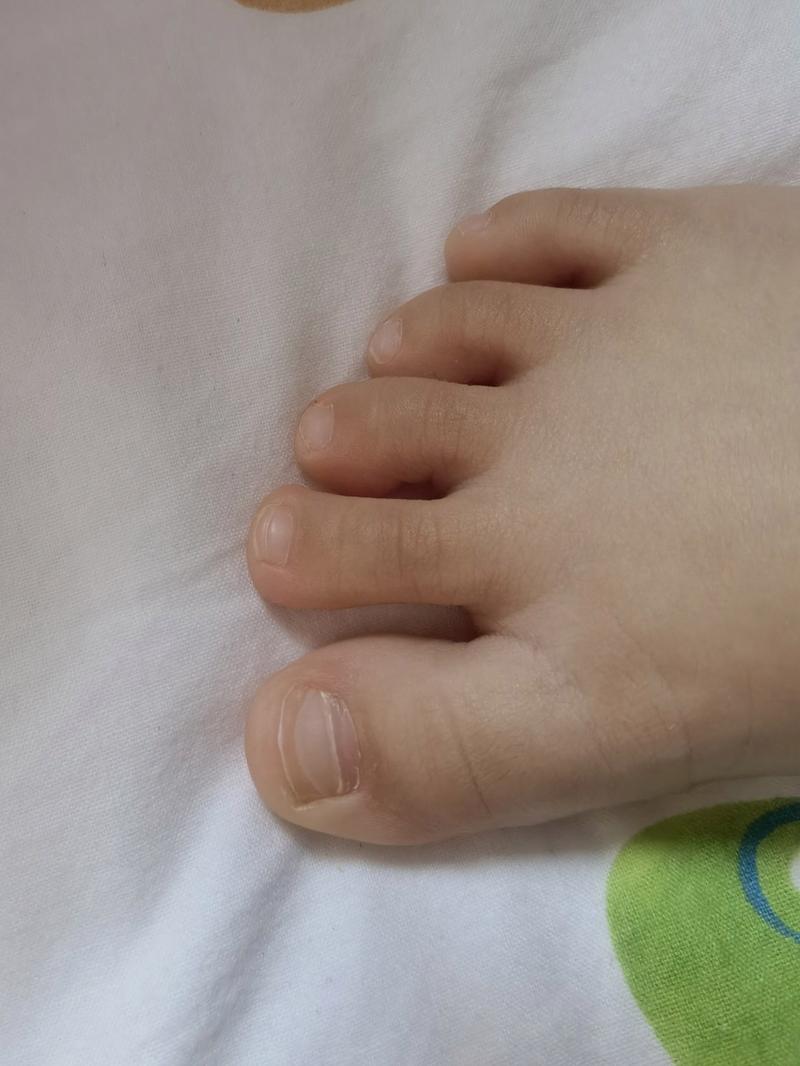 宝宝脚趾甲有横线是怎么回事 今天帮宝宝剪指甲,发现脚趾甲上不知道