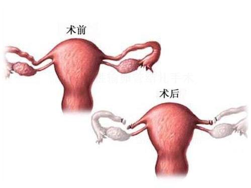 图解女性输卵管结扎手术(图)