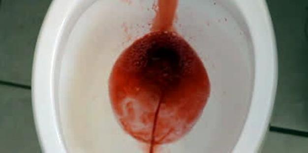 血尿在马桶中的图片