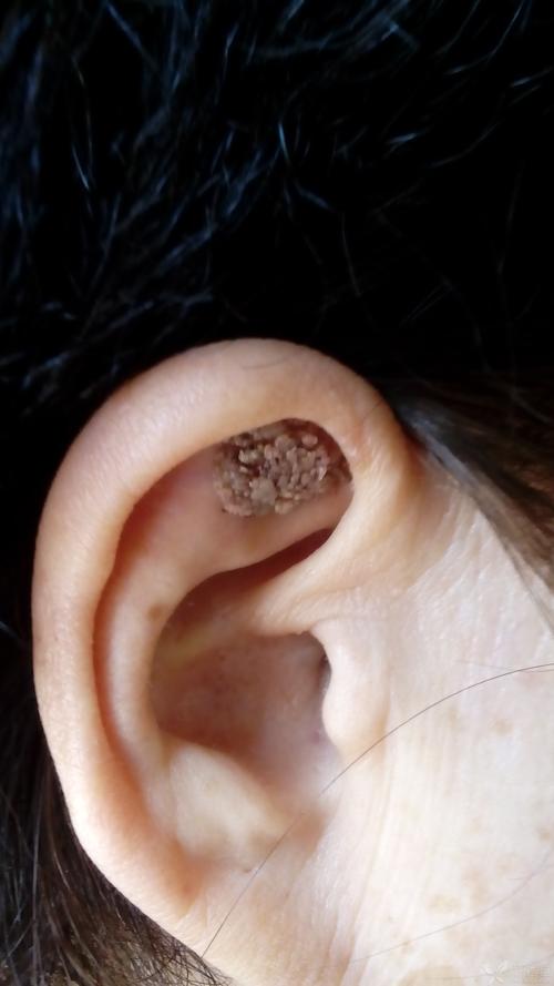 【请教】耳朵上的肿瘤?