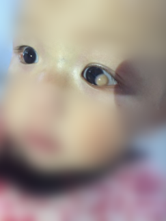 八个月大宝宝眼睛里竟长了囊肿,怎么回事?