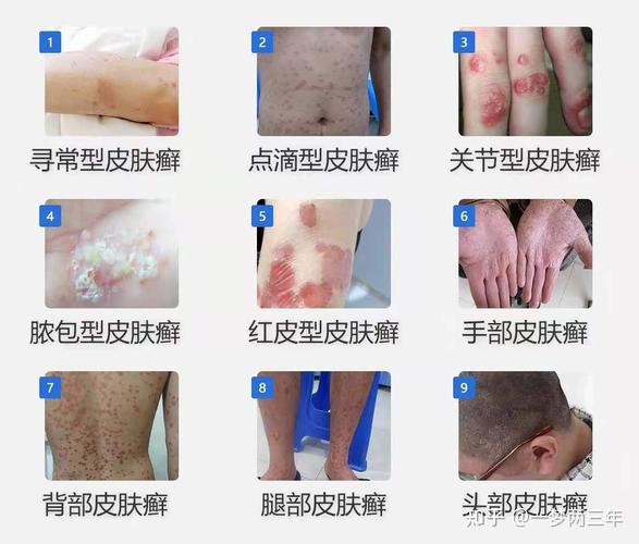 目前皮肤癣菌病