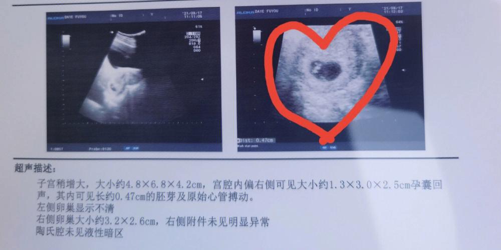 我的宝儿见面胎心胎芽孕囊的位置都很nice仔细一看孕囊的形状呈爱心状