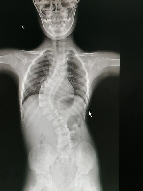 脊柱侧弯手术,患者应该怎样进行康复训练(脊柱侧弯手术后如何进行康复