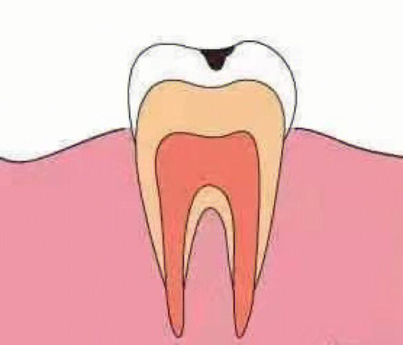 吃糖牙齿痛怎么缓解