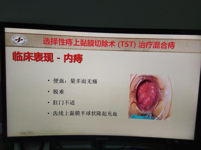 枫泾医院肛肠科特色手术方法介绍---选择性痔上黏膜切除术治疗重度