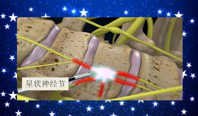 星状神经节阻滞是向颈部包含星状神经节在内的疏松结缔组织内注射局麻