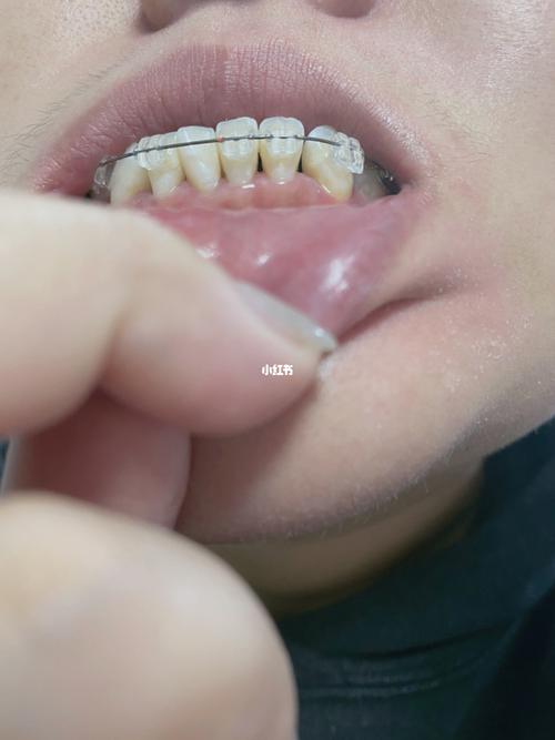 箍牙日记day66——挂皮筋黑三角大牙缝