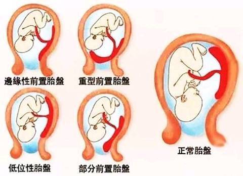 胎盘图片 胎儿性别