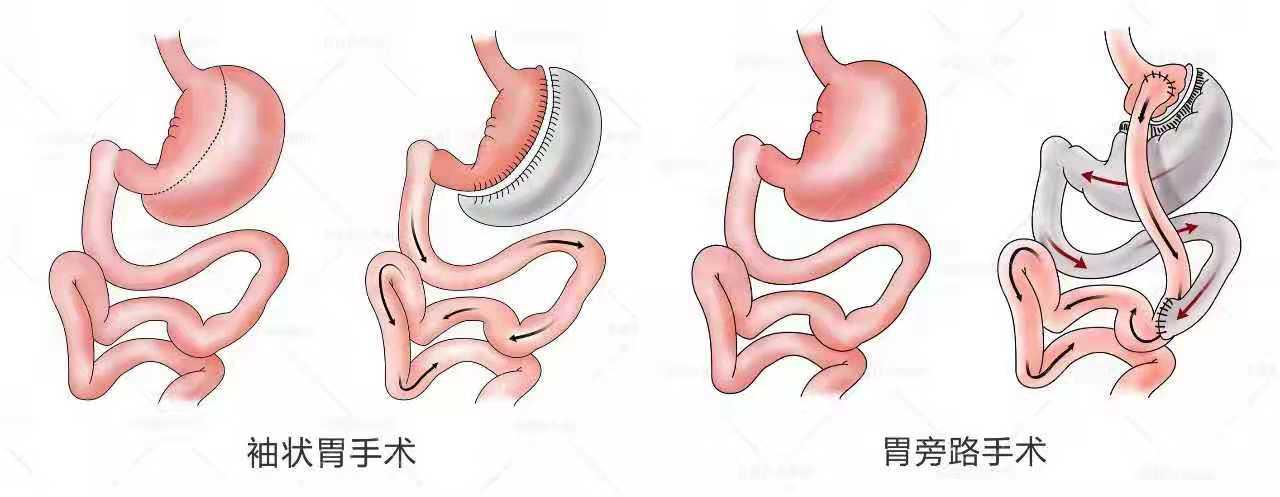 全称腹腔镜缩胃手术,又名袖状胃切除手术(laparoscopicsleeve