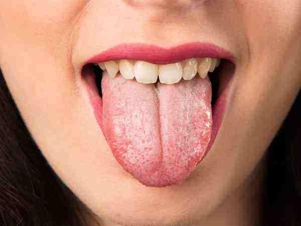 口干舌苔白是怎么回事