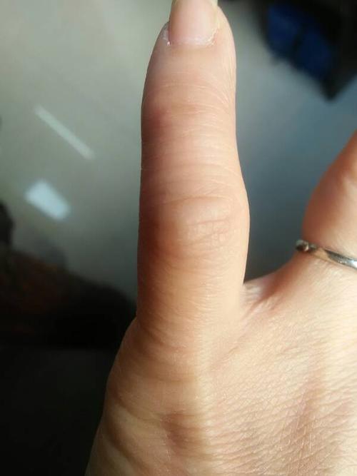 我的小拇指关节不知道为什么有点肿,还痛,哪位专家可以告诉我?