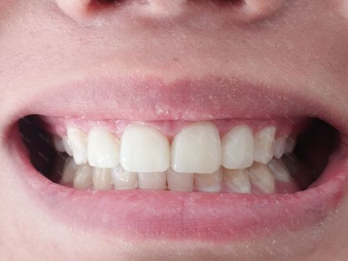 由于牙齿牙缝大,还特别黄,又不想做全瓷牙,这样更容易损害牙齿,所以就