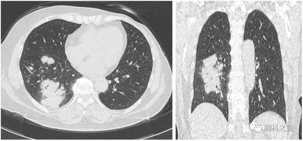 肺隐球菌病的临床特点及影像学特征