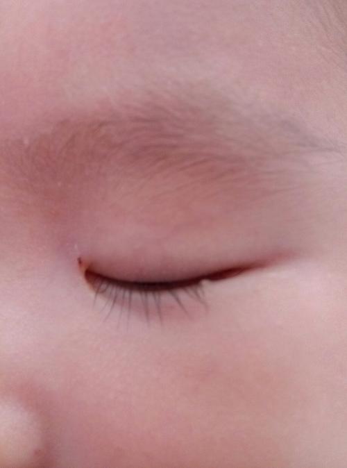 宝宝眼睛下面有个白色的脂肪粒.不影响眼睛,可是感觉不好看,这