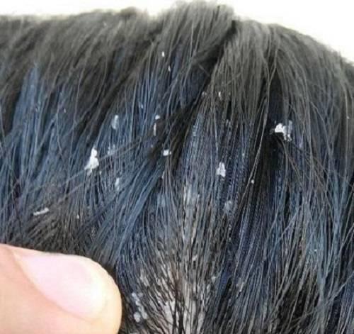 这就是通俗意义上的头皮屑简单来说就是头皮上产生的像雪花一样的白色