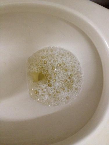 尿有泡泡是什么原因怎么治疗