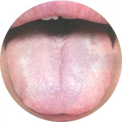 舌苔薄白为正常舌苔或表证初起.