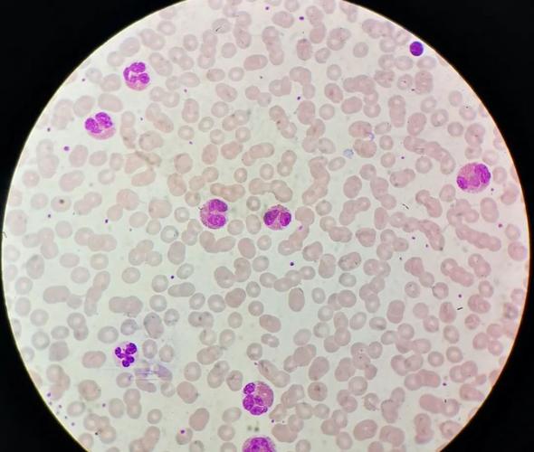 图1血涂片瑞姬染色镜下可见许多典型的嗜酸性粒细胞,手工计数比例和