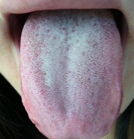 中医望诊:舌苔厚白是怎么回事?当我们胃阴.