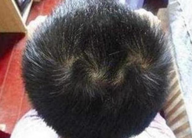 长头发时,由于受到胎儿蠕动的作用,头发就形成了一个像漩涡一样的中心