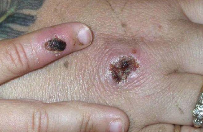 可怕澳洲出现罕见高传染性病毒中招人全身大片红痘可空气传播