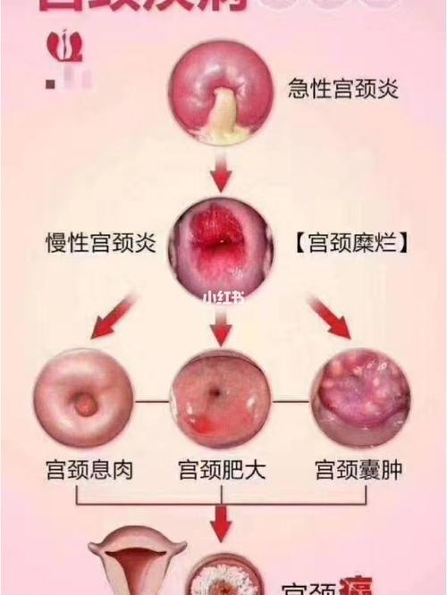 子宫肌瘤变性有以下几种