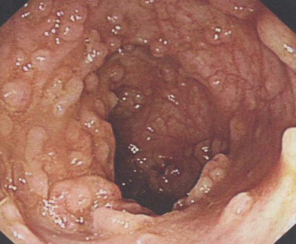 第十三节小肠淋巴滤泡增殖症