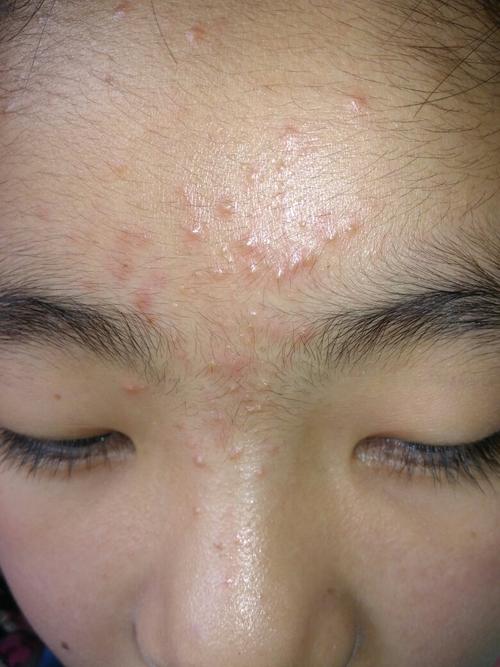 我妹妹额头上长了很多小痘痘,不知道是什么东西,反正应该不是青春痘的