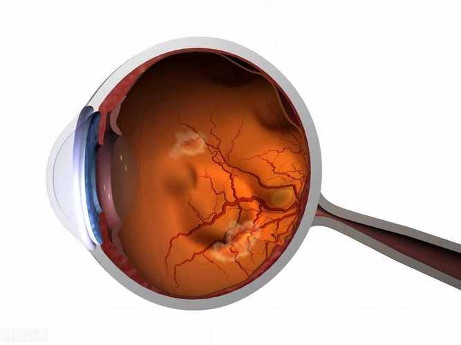 眼底血管硬化眼底毛细血管硬化怎么治疗