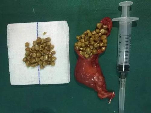 玉兰新技术胆管内掉入47枚结石引发胆源性胰腺炎微创手术去除漂亮的