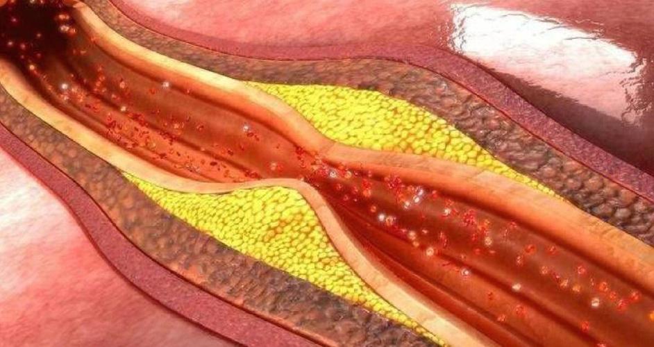 破损的时候你的血液里面的血脂,低密度脂蛋白顺着裂缝渗进血管的内皮
