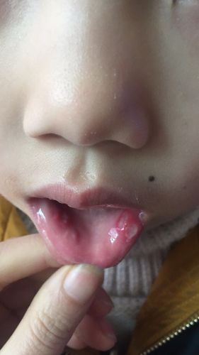 口腔溃疡怎么治疗