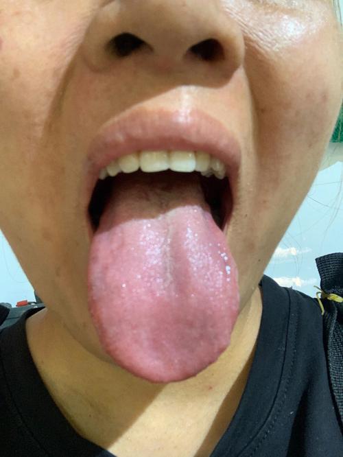 典型的肝肾亏虚的舌苔,你是这样吗?