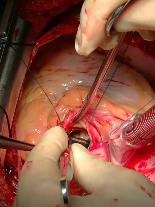 主动脉瓣瓣上狭窄手术方法