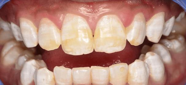 只是把牙齿上的烟渍或牙结石洗掉,并不会改变牙齿的颜色,常见的氟斑牙