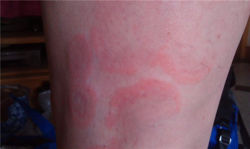 红斑狼疮早期手腕症状图片