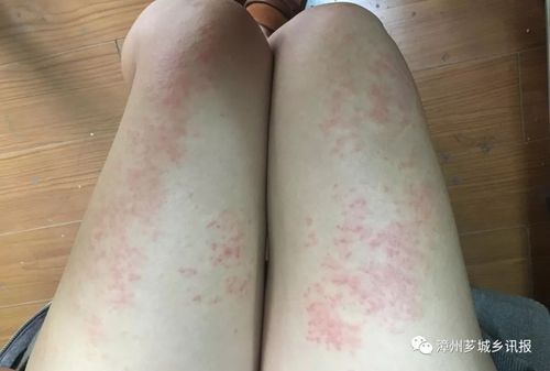 提醒| 国外潜水归来 漳州市区一女子腿上长出大片红疹