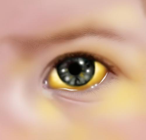 宝宝眼角还有点黄 是黄疸吗