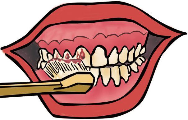 什么病会导致牙龈出血