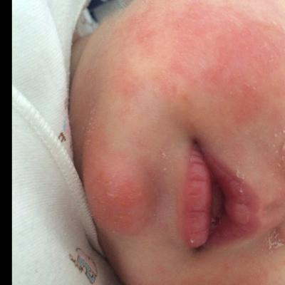 40天小孩脸和下巴越来越红,且红的地方皮肤也开始变