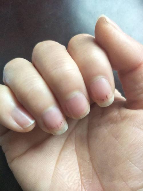 最近手指甲上长了好多黑色的点,不知道是什么原因!