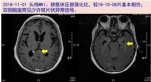 灶(11-01)消失; 双侧脑室旁见少许斑片状异常信号;脑内少许腔隙性缺