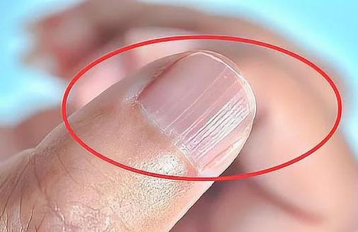 指甲有竖纹是身体的什么信号,指甲有竖纹的原因