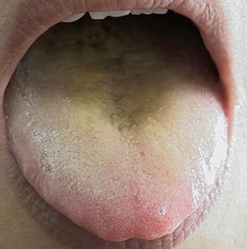 但是舌苔颜色很黄,尤其是舌中部位,舌苔黄腻明显,这种多见是痰湿日久