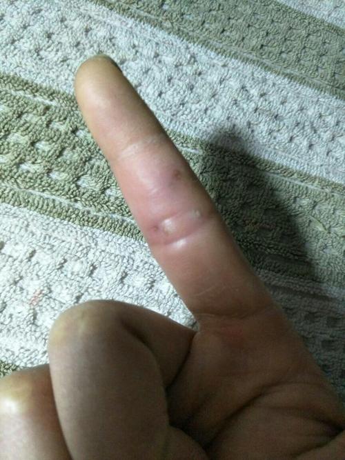 右手食指中间一节前两天无缘无故的又疼又肿,特别是触碰的时候很疼